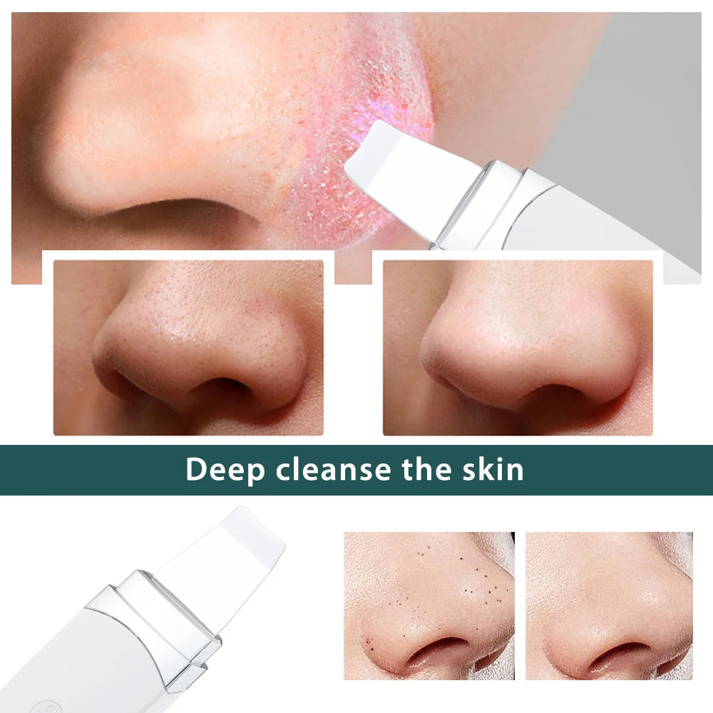 Ultrasonic Skin Scrubber β Blackhead & Pore Cleaner